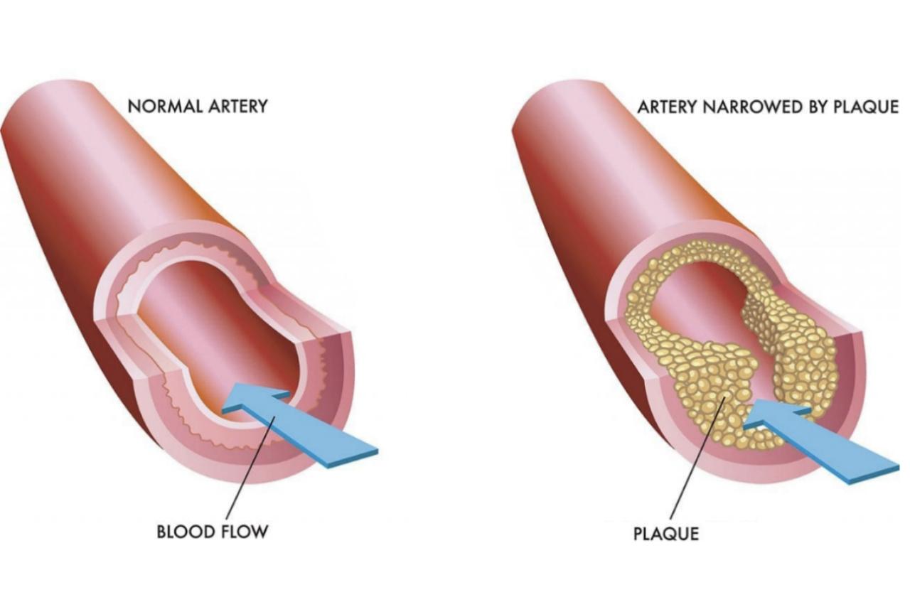 A diagram showing a normal artery and an artery narrowed by plaque
