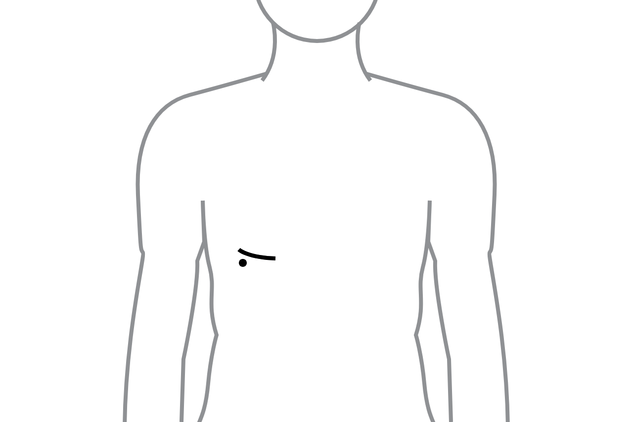 A diagram of minimally invasive surgery