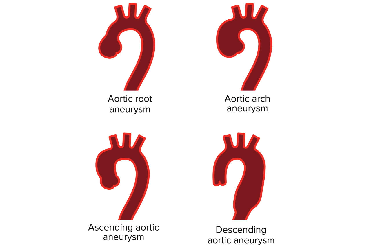 Diagram showing the different types of aortic aneurysms