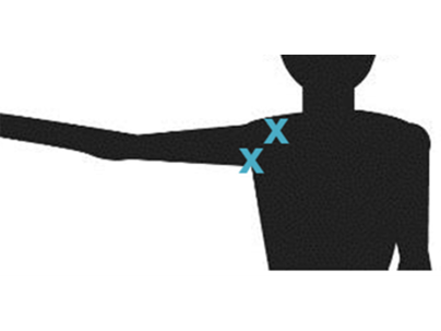 illustration showing possible locations on the under shoulder and top of the shoulder for upper limb nerve blocks