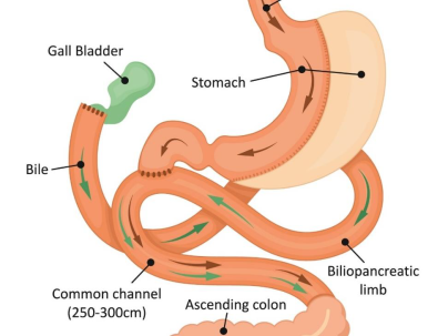 Illustration of the Laparoscopic SADI-S procedure